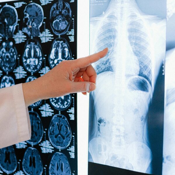 Report | Effects of Xylitol on Bone Health?