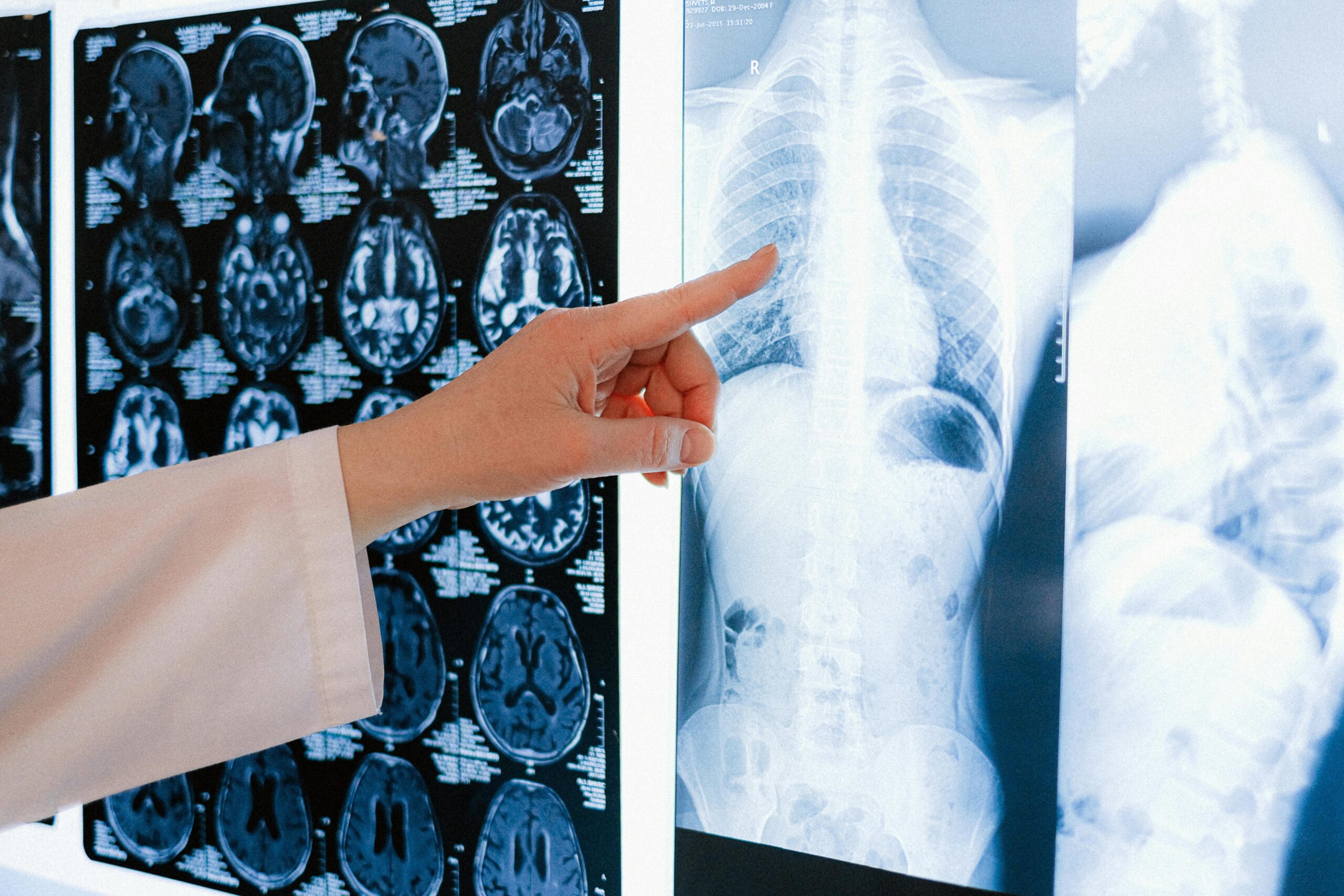 Report | Effects of Xylitol on Bone Health?